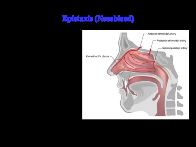 Epistaxis (Nosebleed) Epistaxis is defined as bleeding from the nostril, nasal