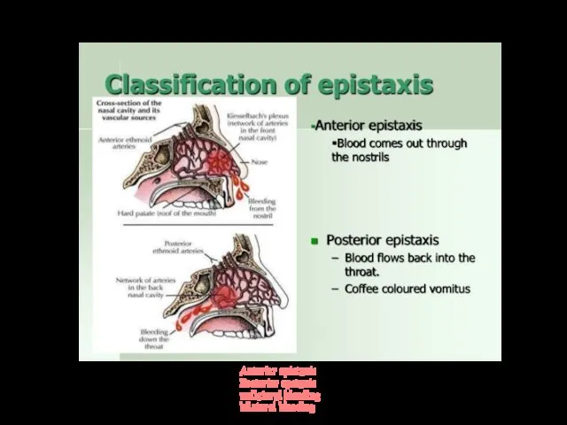 By location: Anterior epistaxis Posterior epstaxis unilateral bleeding bilateral bleeding