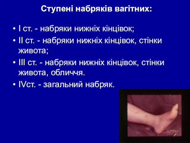 Ступені набряків вагітних: I cт. - набряки нижніх кінцівок; II ст.