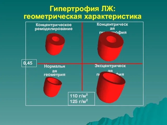 Гипертрофия ЛЖ: геометрическая характеристика Нормальная геометрия Эксцентрическая гипертрофия Концентрическое ремоделирование Концентрическая