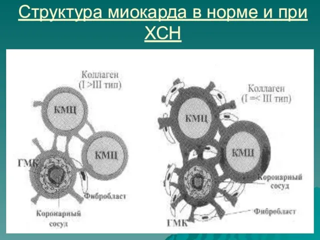 Структура миокарда в норме и при ХСН