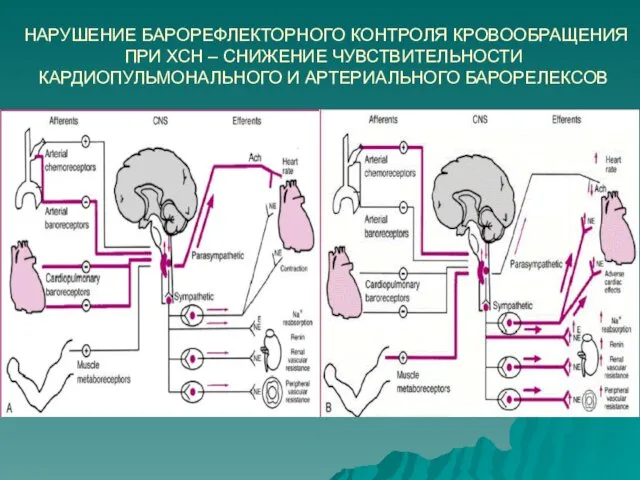 НАРУШЕНИЕ БАРОРЕФЛЕКТОРНОГО КОНТРОЛЯ КРОВООБРАЩЕНИЯ ПРИ ХСН – СНИЖЕНИЕ ЧУВСТВИТЕЛЬНОСТИ КАРДИОПУЛЬМОНАЛЬНОГО И АРТЕРИАЛЬНОГО БАРОРЕЛЕКСОВ