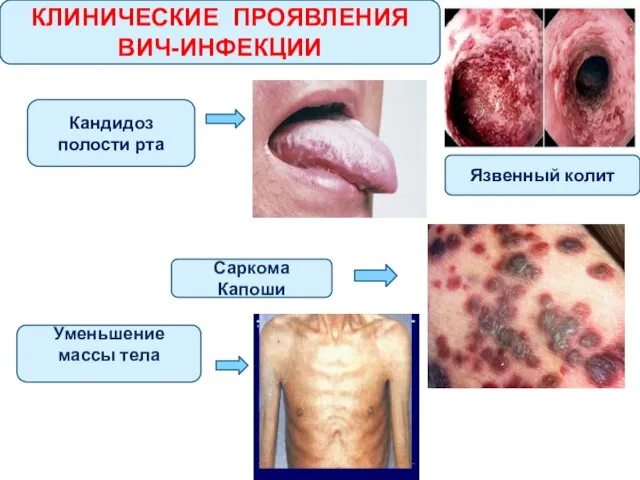 КЛИНИЧЕСКИЕ ПРОЯВЛЕНИЯ ВИЧ-ИНФЕКЦИИ Кандидоз полости рта Саркома Капоши Уменьшение массы тела Язвенный колит