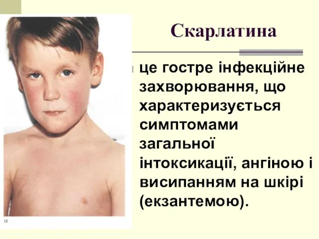 Скарлатина це гостре інфекційне захворювання, що характеризується симптомами загальної інтоксикації, ангіною і висипанням на шкірі (екзантемою).