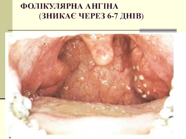 ФОЛІКУЛЯРНА АНГІНА (ЗНИКАЄ ЧЕРЕЗ 6-7 ДНІВ)