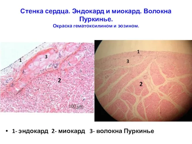 Стенка сердца. Эндокард и миокард. Волокна Пуркинье. Окраска гематоксилином и эозином.