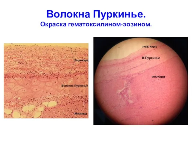 Волокна Пуркинье. Окраска гематоксилином-эозином. эндокард В.Пуркинье миокард