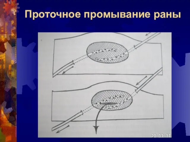 Проточное промывание раны