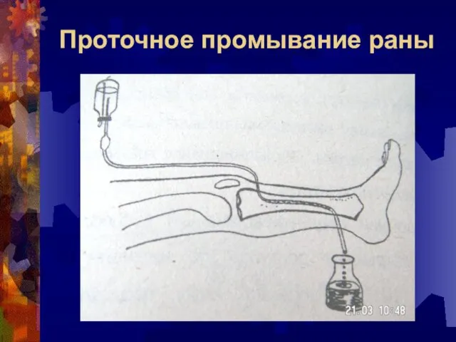 Проточное промывание раны