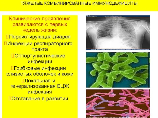 ТЯЖЕЛЫЕ КОМБИНИРОВАННЫЕ ИММУНОДЕФИЦИТЫ Клинические проявления развиваются с первых недель жизни: Персистирующая