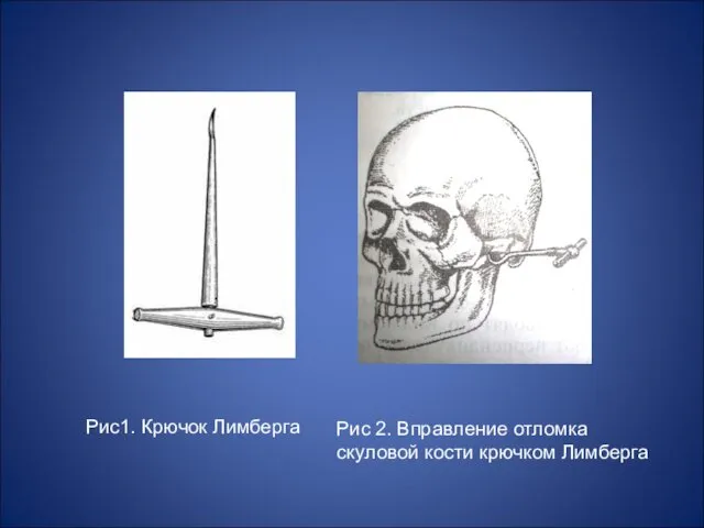 Рис1. Крючок Лимберга Рис 2. Вправление отломка скуловой кости крючком Лимберга