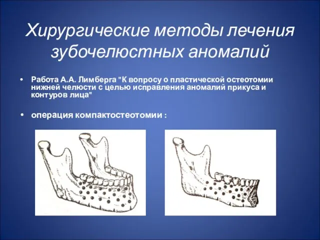 Хирургические методы лечения зубочелюстных аномалий Работа А.А. Лимберга "К вопросу о