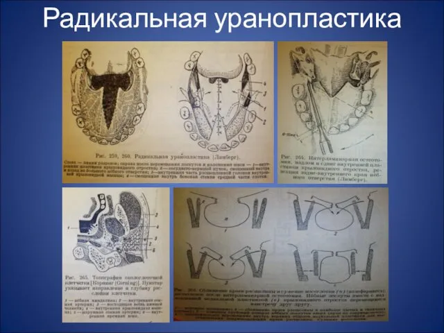 Радикальная уранопластика