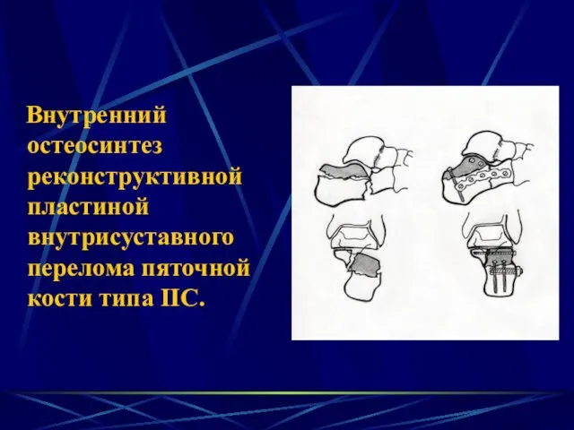 Внутренний остеосинтез реконструктивной пластиной внутрисуставного перелома пяточной кости типа IIС.