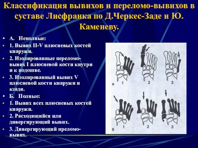 Классификация вывихов и переломо-вывихов в суставе Лисфранка по Д.Черкес-Заде и Ю.Каменеву.