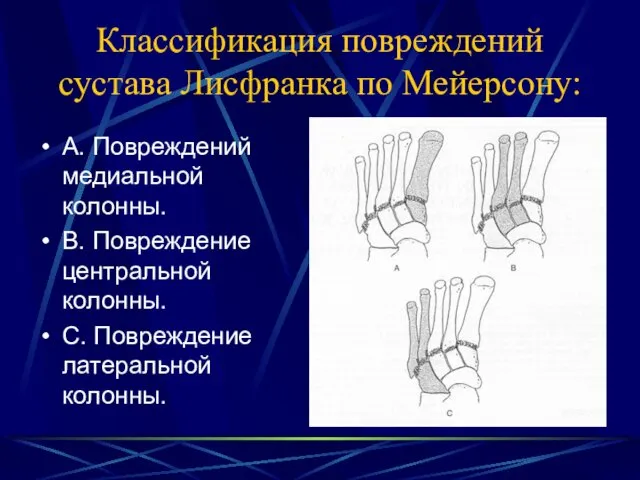 Классификация повреждений сустава Лисфранка по Мейерсону: А. Повреждений медиальной колонны. В.