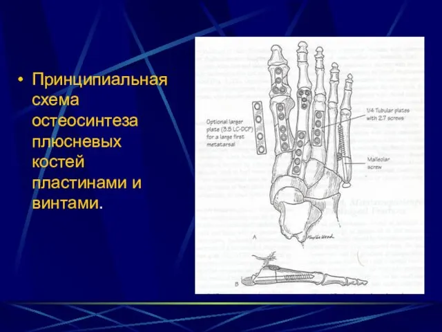 Принципиальная схема остеосинтеза плюсневых костей пластинами и винтами.