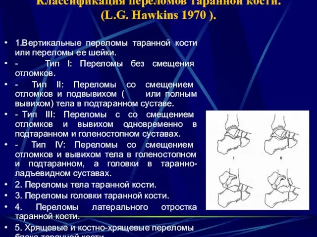 Классификация переломов таранной кости. (L.G. Hawkins 1970 ). 1.Вертикальные переломы таранной