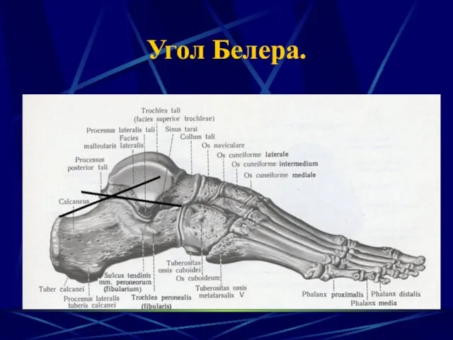 Угол Белера.