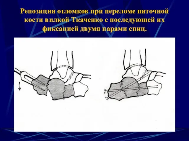 Репозиция отломков при переломе пяточной кости вилкой Ткаченко с последующей их фиксацией двумя парами спиц.