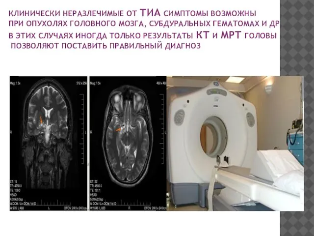 КЛИНИЧЕСКИ НЕРАЗЛЕЧИМЫЕ ОТ ТИА СИМПТОМЫ ВОЗМОЖНЫ ПРИ ОПУХОЛЯХ ГОЛОВНОГО МОЗГА, СУБДУРАЛЬНЫХ