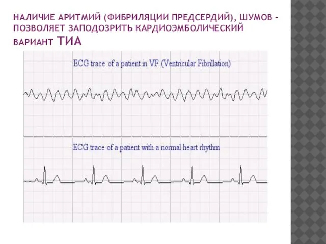 НАЛИЧИЕ АРИТМИЙ (ФИБРИЛЯЦИИ ПРЕДСЕРДИЙ), ШУМОВ – ПОЗВОЛЯЕТ ЗАПОДОЗРИТЬ КАРДИОЭМБОЛИЧЕСКИЙ ВАРИАНТ ТИА