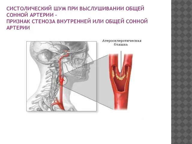 СИСТОЛИЧЕСКИЙ ШУМ ПРИ ВЫСЛУШИВАНИИ ОБЩЕЙ СОННОЙ АРТЕРИИ – ПРИЗНАК СТЕНОЗА ВНУТРЕННЕЙ ИЛИ ОБЩЕЙ СОННОЙ АРТЕРИИ