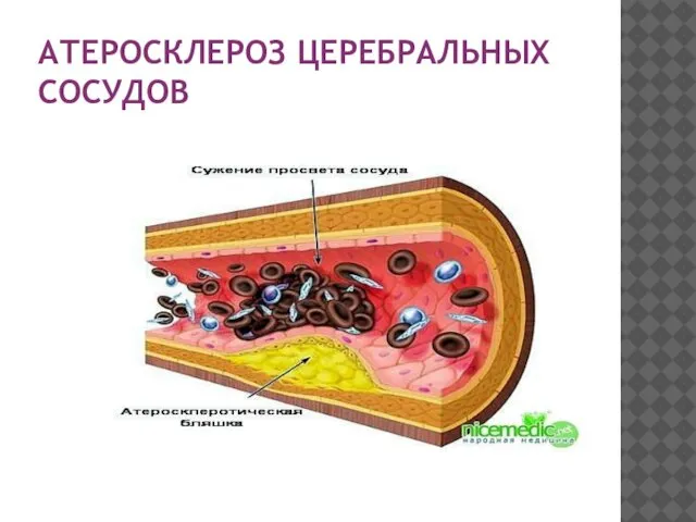 АТЕРОСКЛЕРОЗ ЦЕРЕБРАЛЬНЫХ СОСУДОВ