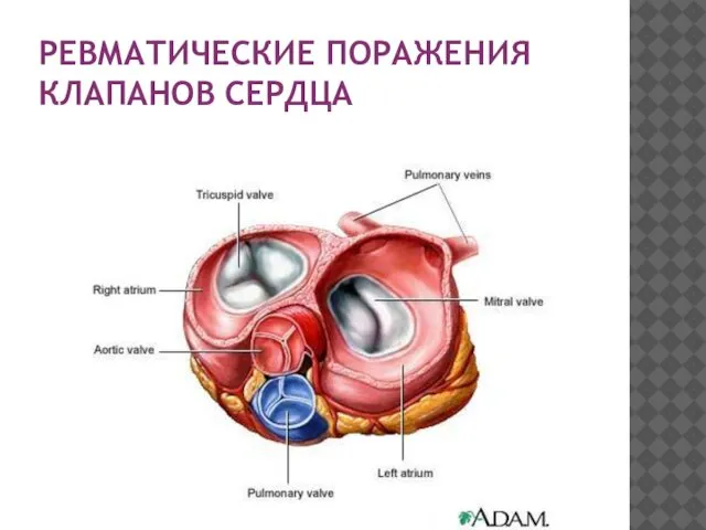 РЕВМАТИЧЕСКИЕ ПОРАЖЕНИЯ КЛАПАНОВ СЕРДЦА