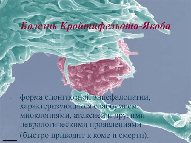 Болезнь Кройтцфельдта-Якоба форма спонгиозной энцефалопатии, характеризующаяся слабоумием, миоклониями, атаксией и другими