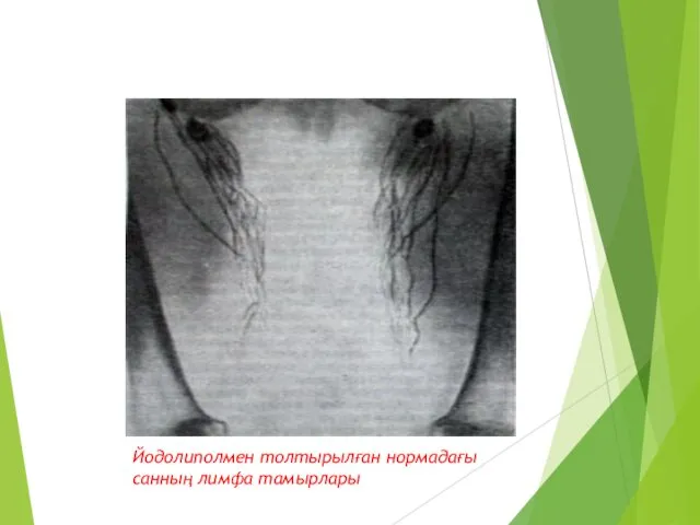 Йодолиполмен толтырылған нормадағы санның лимфа тамырлары