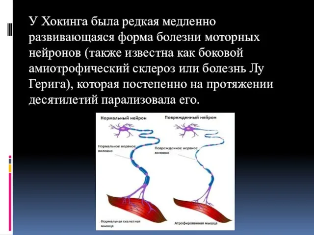 У Хокинга была редкая медленно развивающаяся форма болезни моторных нейронов (также