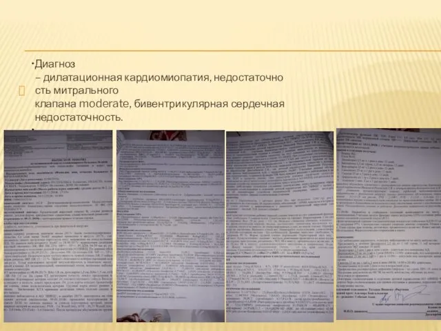 Диагноз – дилатационная кардиомиопатия, недостаточность митрального клапана moderate, бивентрикулярная сердечная недостаточность.​ ​