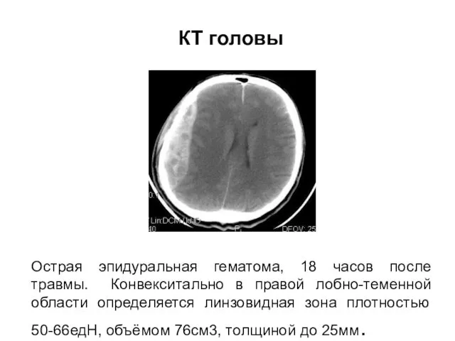 Острая эпидуральная гематома, 18 часов после травмы. Конвекситально в правой лобно-теменной