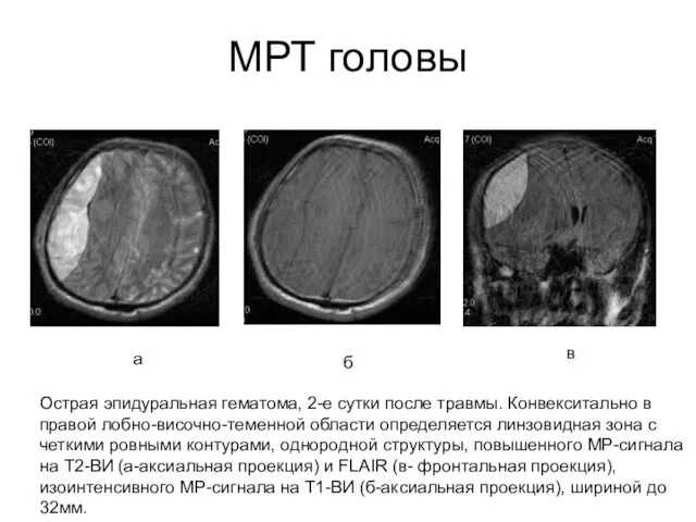 МРТ головы Острая эпидуральная гематома, 2-е сутки после травмы. Конвекситально в