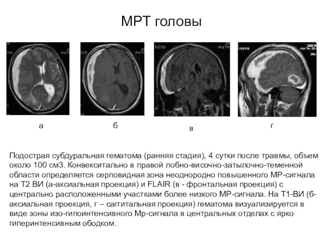 МРТ головы Подострая субдуральная гематома (ранняя стадия), 4 сутки после травмы,