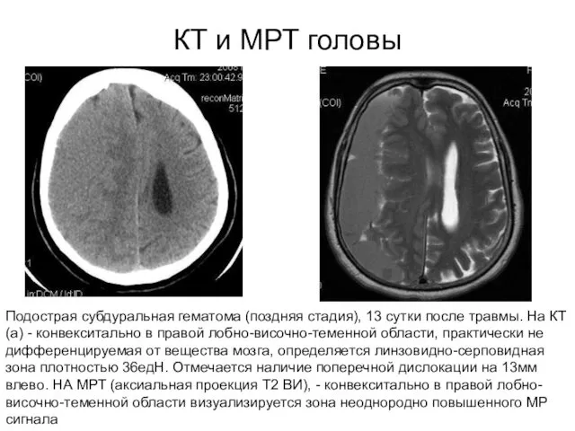 КТ и МРТ головы Подострая субдуральная гематома (поздняя стадия), 13 сутки