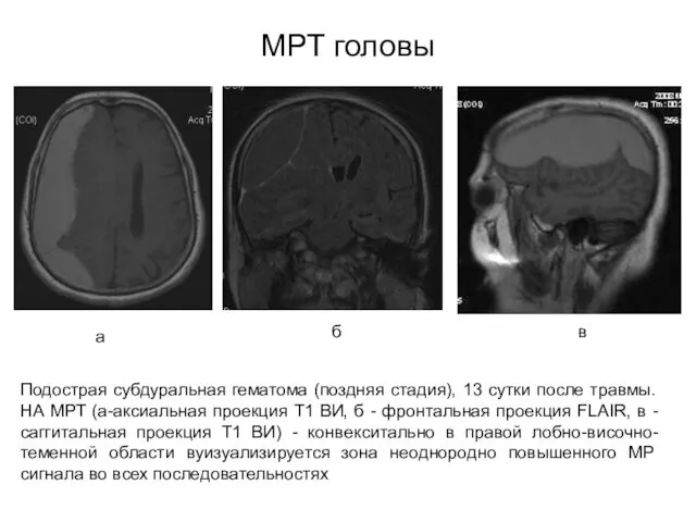 МРТ головы Подострая субдуральная гематома (поздняя стадия), 13 сутки после травмы.