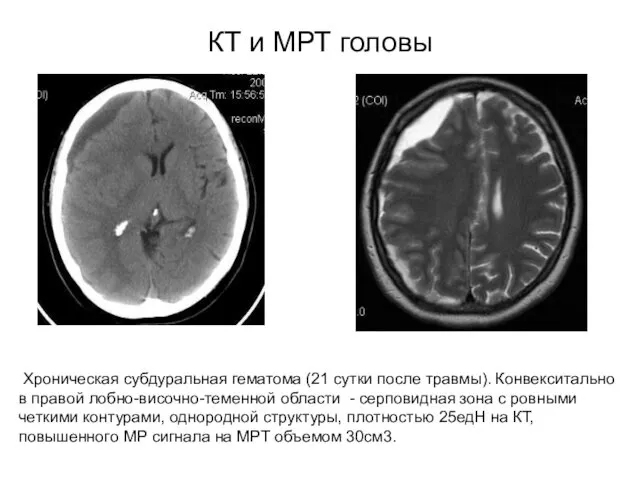 КТ и МРТ головы Хроническая субдуральная гематома (21 сутки после травмы).