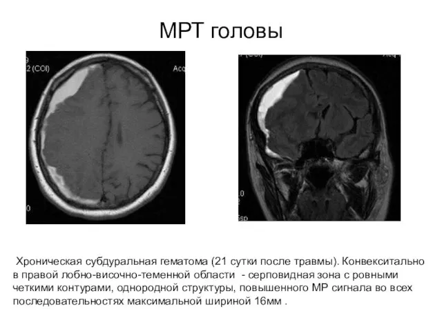 МРТ головы Хроническая субдуральная гематома (21 сутки после травмы). Конвекситально в