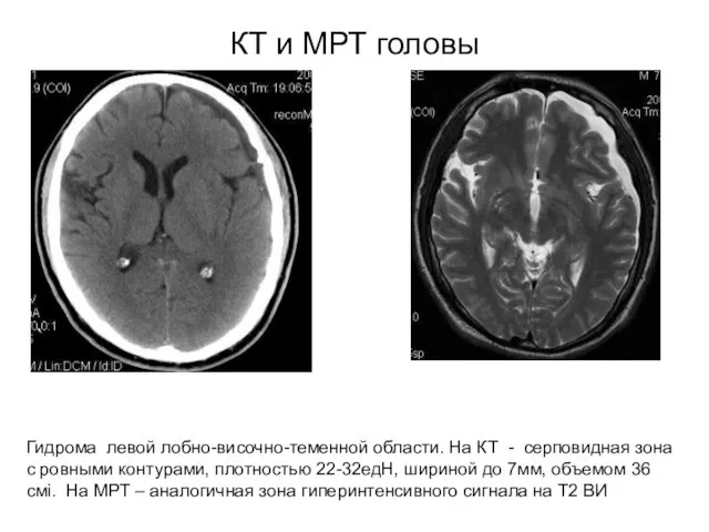 КТ и МРТ головы Гидрома левой лобно-височно-теменной области. На КТ -