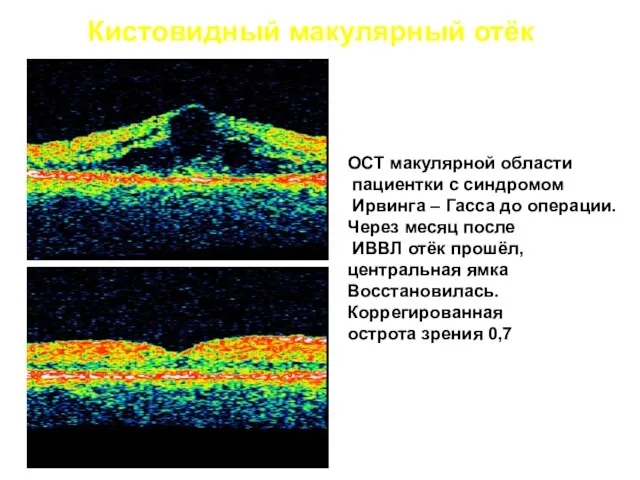 Кистовидный макулярный отёк ОСТ макулярной области пациентки с синдромом Ирвинга –