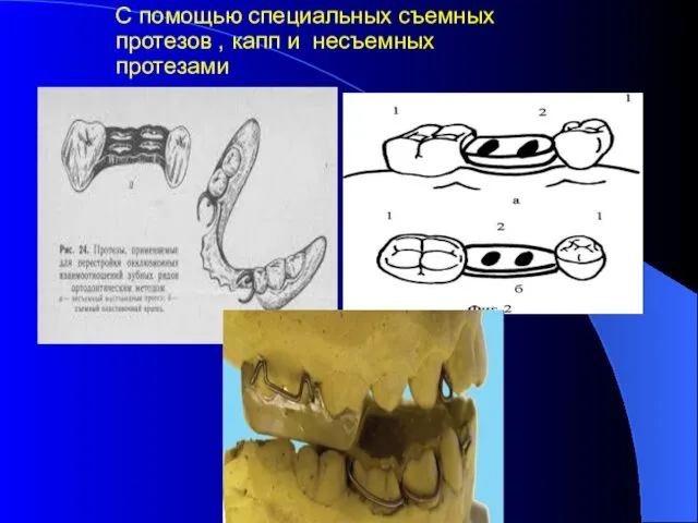 С помощью специальных съемных протезов , капп и несъемных протезами