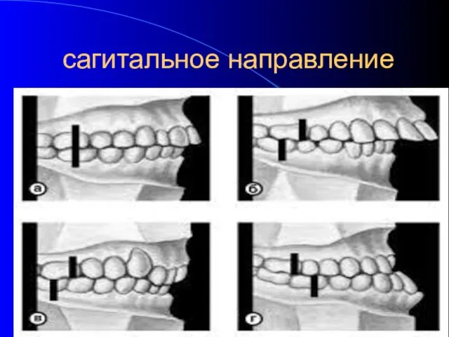 сагитальное направление