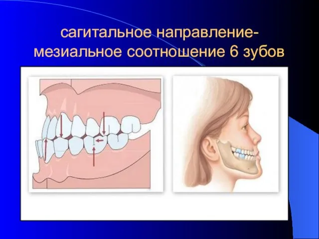 сагитальное направление-мезиальное соотношение 6 зубов