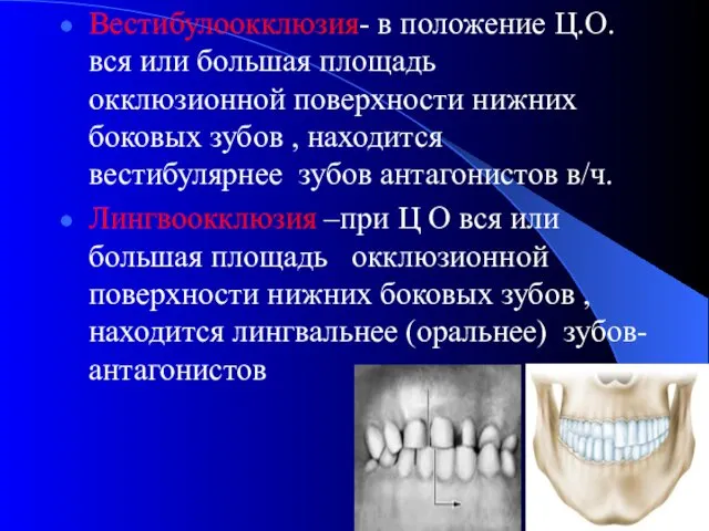 Вестибулоокклюзия- в положение Ц.О. вся или большая площадь окклюзионной поверхности нижних