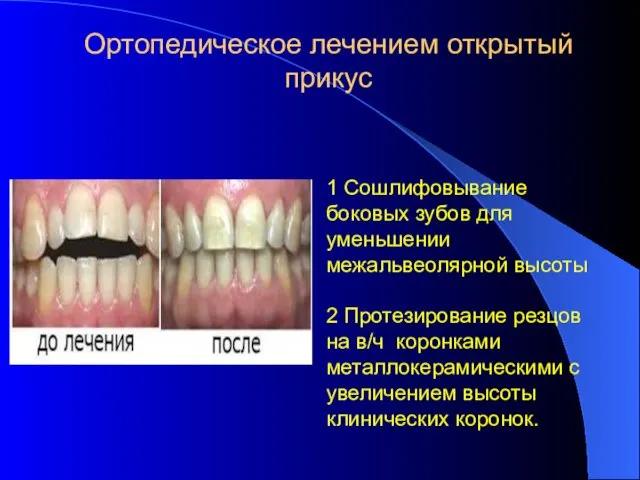 Ортопедическое лечением открытый прикус 1 Сошлифовывание боковых зубов для уменьшении межальвеолярной