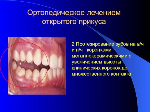 Ортопедическое лечением открытого прикуса 2 Протезирование зубов на в/ч и н/ч