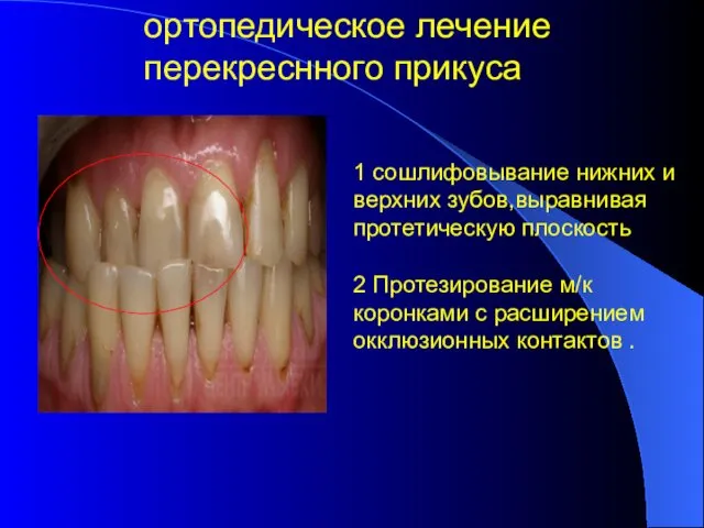 ортопедическое лечение перекреснного прикуса 1 сошлифовывание нижних и верхних зубов,выравнивая протетическую