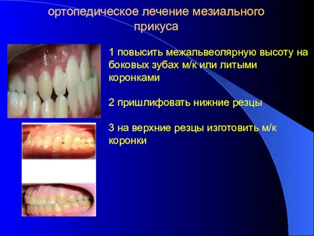 ортопедическое лечение мезиального прикуса 1 повысить межальвеолярную высоту на боковых зубах